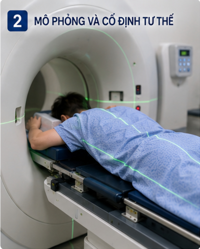 CyberKnife điều trị u cột sống