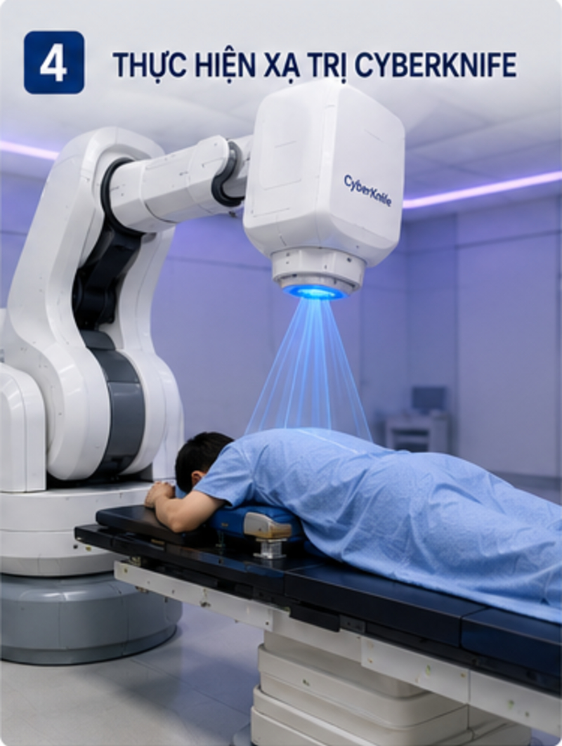 CyberKnife điều trị u cột sống