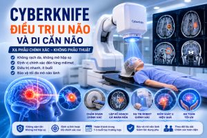 CyberKnife điều trị u não