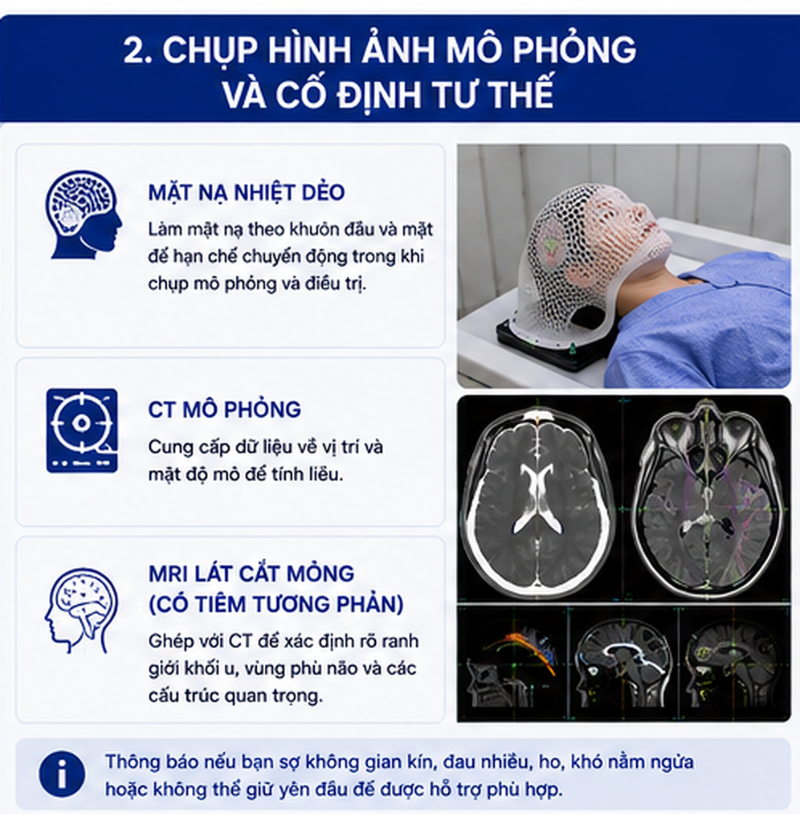 CyberKnife điều trị u não