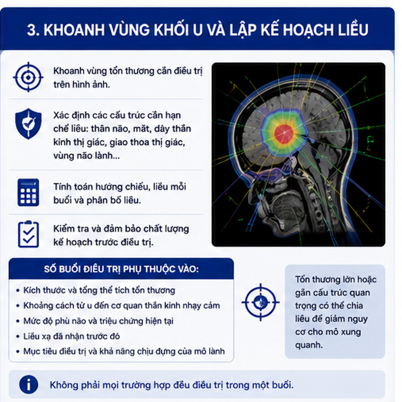 CyberKnife điều trị u não