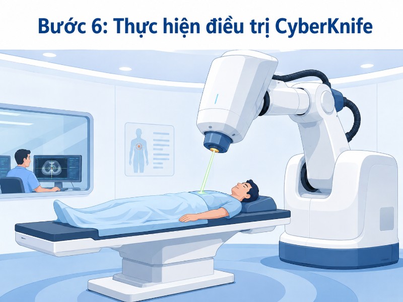 Quy trình điều trị CyberKnife