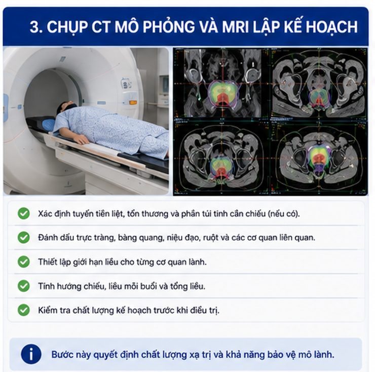 CyberKnife điều trị ung thư tuyến tiền liệt